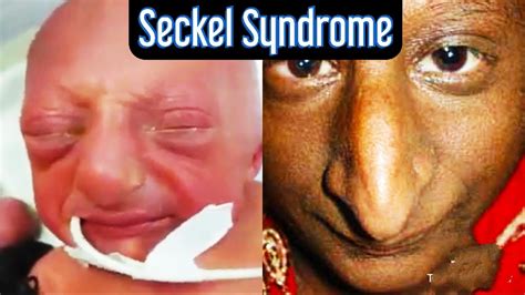 virchow seckel syndrome